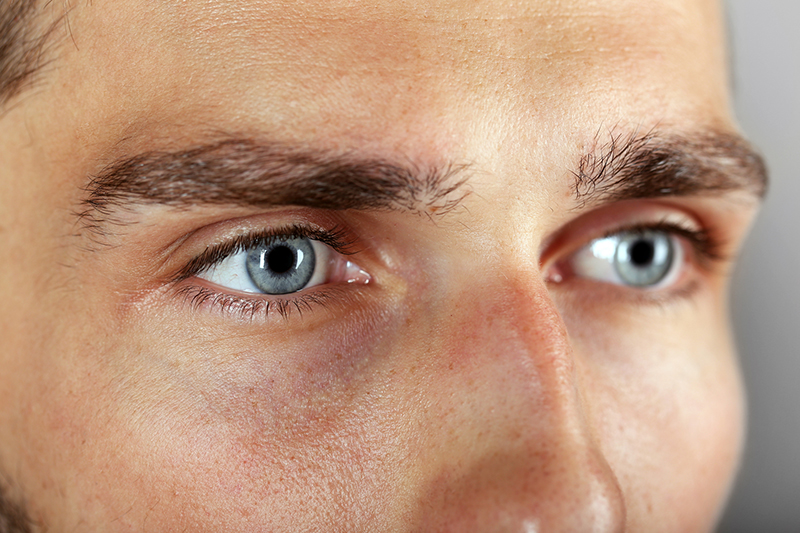 how to get rid of xanthelasma around eyes naturally